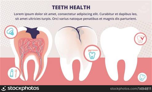 Healthy and Unhealthy Teeth Stand in Raw. Tooth Decay Cross Section with all Parts and Caries Hole. Dentistry Health Icons with Implant, Toothpaste and Brush Cartoon Flat Vector Illustration, Banner. Healthy and Unhealthy Teeth Stand in Raw Banner