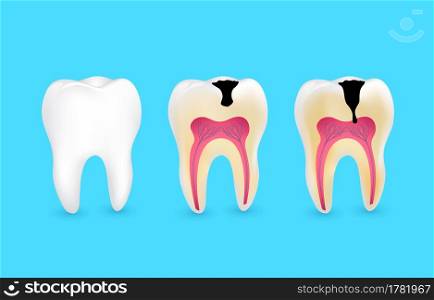 Healthy tooth and tooth caries. Superficial caries; deep caries; enamel and dentin decay; periodontitis.