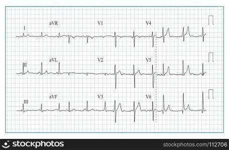 Heart Cardiogram Chart Vector. Illustration Of Wave Form On Checked Ecg Graph. Heart Rhythm, Ischemia, Infarction. Vitality Heartbeat. Heart Cardiogram Chart Vector. Illustration Of Wave Form On Checked Ecg Graph. Heart Rhythm, Ischemia, Infarction. Heartbeat
