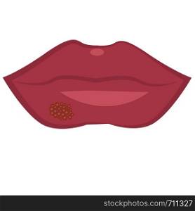 Herpes on lips cold sores viral infection vector illustration isolated on a white background