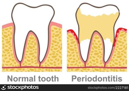 Human gum bleeding - periodontal disease  oral care vector illustration, gingivitis 