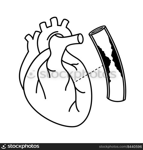 Human heart with Coronary Artery Disease. Outline info graphic. Blocked artery, heart awareness concept. Vector illustration.