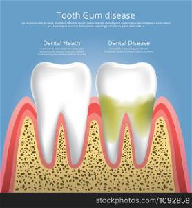 Human teeth Stages of Gum Disease Vector Illustration