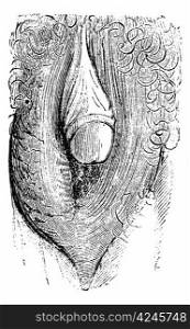 Hypertrophy of the clitoris simulating gland of man and can make people believe a hermaphroditism of the individual (strong), vintage engraved illustration. Magasin Pittoresque 1875.