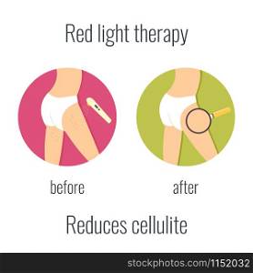 Illustration of a girl with cellullite and without. Red light therapy treatment. Before and after icon. Illustration of a girl with cellullite and without