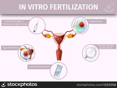 In Vitro Fertilization Stages Infographic. Human Reproduction. Union ...