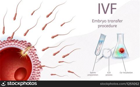 In Vitro Fertilization Embryo Transfer Procedure. IVF Process Chart with Schematic Explanations and Icons. Sperm Preparetion, ICSI Process, Co-Incubation. Realistic Vector Illustration, Medical Banner. In Vitro Fertilization Embryo Transfer Procedure.