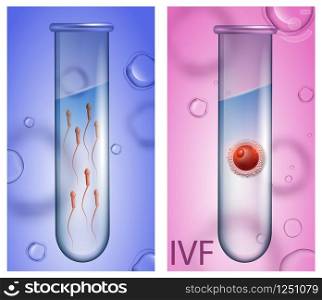 In Vitro Fertilization Vertical Banners. Male Test Tube with Active Spermatozoons on Blue Background, Female Beaker with Egg Cell on Pink Backdrop. IVF. Vector Realistic Illustration for Medical Use. Male Test Tube with Sperm, Female Beaker with Egg