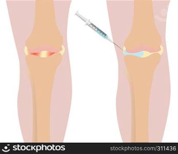 Knee injection inflamation before and after injection to injured knee vector illustration