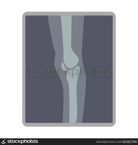 Knee x ray image semi flat color vector object. Patella dislocation. Avulsion fracture. Full sized item on white. Ligament injury simple cartoon style illustration for web graphic design and animation. Knee x ray image semi flat color vector object