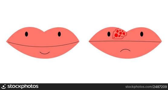 lips closeup with cold herpes, sore on the lip, vector.. lips closeup with cold herpes, sore on the lip, vector illustration