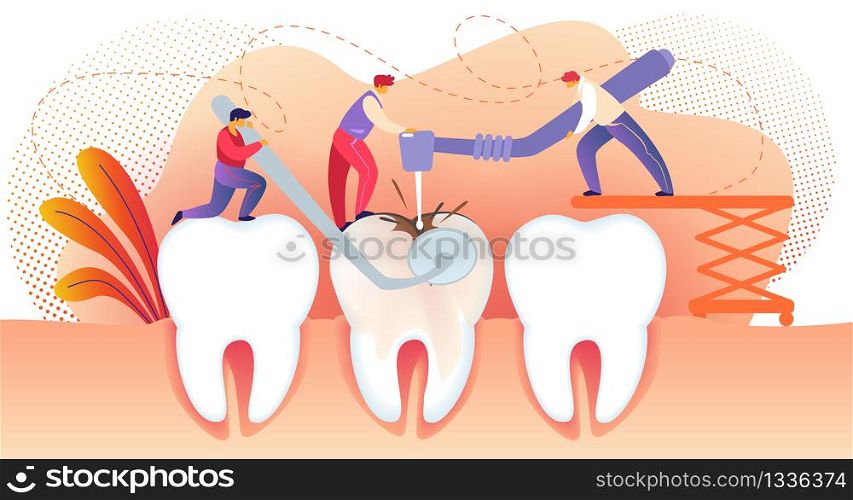 Little People Drilling Huge Unhealthy Tooth with Caries Hole. Teeth Treating. Man Holding Dentistry Mirror. People Working Together. Stomatology. Dental Disease. Cartoon Flat Vector Illustration.. Little People Drilling Unhealthy Tooth with Caries