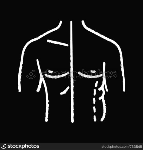 Male coolsculpting chalk icon. Flanks correction. Male liposuction and body contouring before and after. Plastic surgery. Isolated vector chalkboard illustration. Male coolsculpting chalk icon