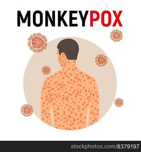 Man sick with monkey smallpox in flat style isolated on white background. Background with monkey pox virus. Vector illustration.. Man sick with monkey smallpox in flat style 