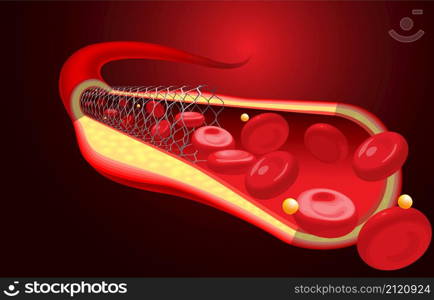 Medical and educational illustrations of the stent are already inserted, improving blood flow.