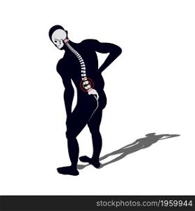 Medical Concept Illustration of Musculotendinous Strain Back Ache or Lumbar Pain.