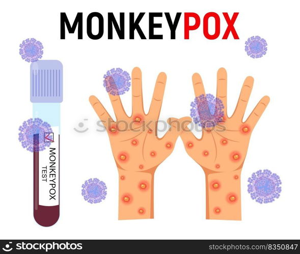 Monkey pox background. A test tube with blood for a test and a human hand with a rash and ulcers surrounded by viral cells on a white background. Disease symptoms. Vector illustration.. test tube with blood and a human hand with a rash