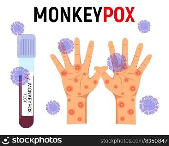 Monkey pox background. A test tube with blood for a test and a human hand with a rash and ulcers surrounded by viral cells on a white background. Disease symptoms. Vector illustration.. test tube with blood and a human hand with a rash