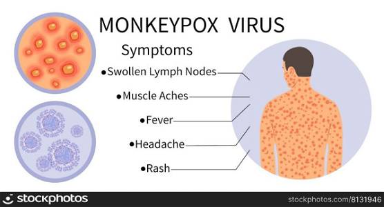Monkeypox virus banner for symptom awareness. Monkeypox virus symptoms infographic. Human body with rash. Symptoms of the disease - Swollen Lymph Nodes, Muscle Aches, Fever, Headache, Rash.Vector.
