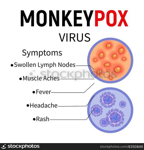 Monkeypox virus. Enlarged samples of human skin with ulcers and virus cells. Monkeypox disease symptoms infographic. Vector illustration.. samples of human skin with ulcers and virus cells
