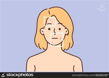 Naked woman with red pimples on face suffer from dermatitis. Unhappy female with redness or allergy struggle with facial problem. Skincare. Vector illustration. . Woman with red pimples on face 