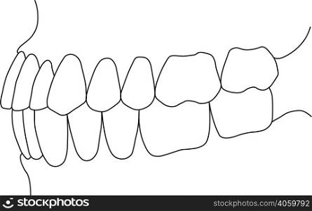 orthognathic dental occlusion on white background. dental bite