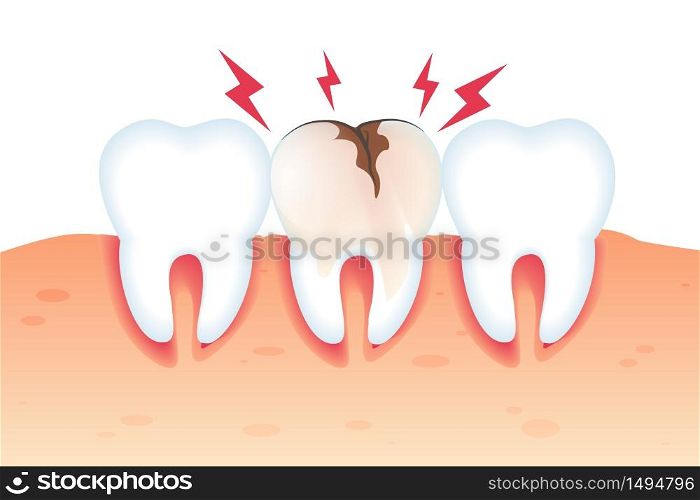 Pain in Broken Tooth Illustration Realistic 3d. Special Assistance in Maintaining Oral Hygiene. Closeup Healthy White Teeth and Tooth Need Repair. Vector Flat. Dental Diseases and Pain.