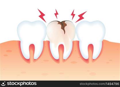 Pain in Broken Tooth Illustration Realistic 3d. Special Assistance in Maintaining Oral Hygiene. Closeup Healthy White Teeth and Tooth Need Repair. Vector Flat. Dental Diseases and Pain.