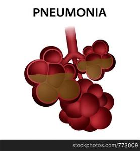 Pneumonia alveoli icon. Realistic illustration of pneumonia alveoli vector icon for web design isolated on white background. Pneumonia alveoli icon, realistic style