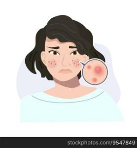Portrait of Stressed Female with Troubled Skin. Acne, Papule Skin Close Up. Flat vector cartoon illustration
