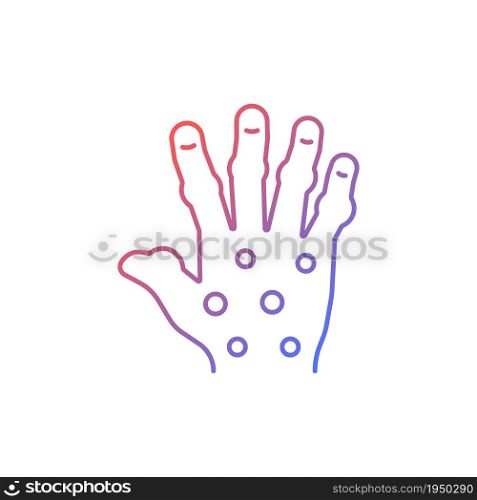 Psoriatic arthritis gradient linear vector icon. Painful hand joints. Permanent bones damage. Fingers deformity. Thin line color symbol. Modern style pictogram. Vector isolated outline drawing. Psoriatic arthritis gradient linear vector icon