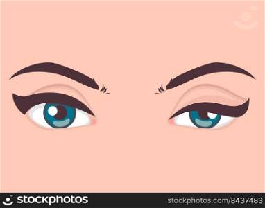 Ptosis. Normal eyelid and falling of the upper eyelid. eye drooping disease, Vector illustration. Ptosis of the upper eyelid, optical problem with eye, medical vector illustration