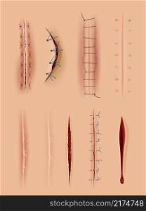 Realistic scars. Medical surgical sutures wounds close up pictures on human skin decent vector illustrations set. Injured sewing, wounded and zigzag string. Realistic scars. Medical surgical sutures wounds close up pictures on human skin decent vector illustrations set