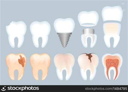 Realistic Tooth Structure Vector Illustration. Close-up Structure Teeth. Healthy Natural Tooth and its Destruction. Problems with Enamel. Healthy Dental Implant and its Structure 3d.