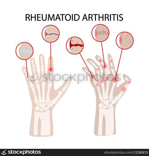 RHEUMATOID ARTHRITIS DISEASE Medicine Education Vector Scheme