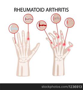 RHEUMATOID ARTHRITIS DISEASE Medicine Education Vector Scheme