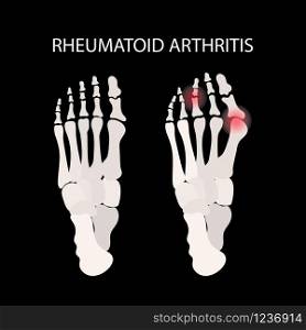 RHEUMATOID ARTHRITIS LEG Medicine Education Vector Scheme