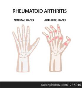 RHEUMATOID ARTHRITIS WHITE Medicine Education Vector Scheme