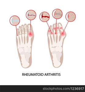 RHEUMATOID DISEASE LEG Arhtritis Medicine Education Scheme