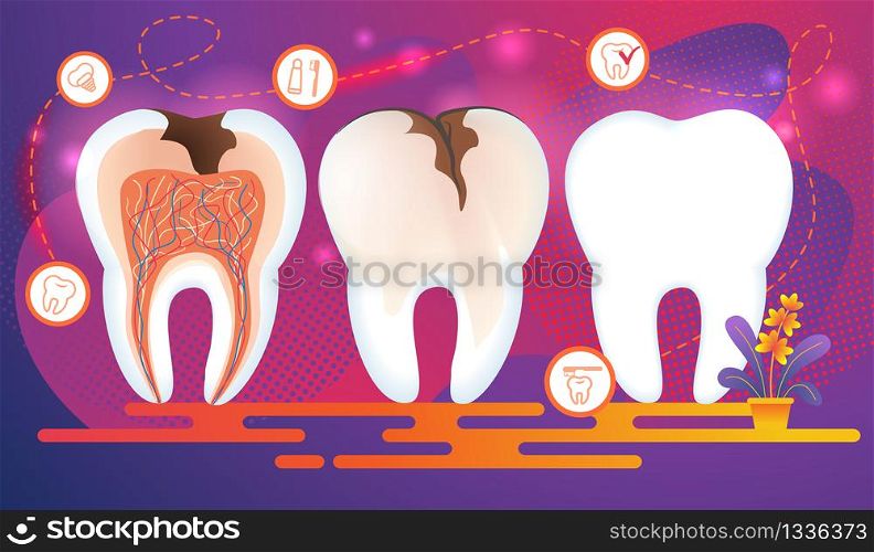 Row of Teeth with Dental Problems. Cross Section of Tooth with Caries Hole and Nerves. Stomatology Icons on Purple Gradient Sparkling Background. Toothpaste, Brush, Implantat Flat Vector Illustration.. Row of Teeth with Dental Problems. Cross Section.