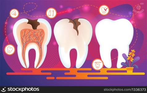 Row of Teeth with Dental Problems. Cross Section of Tooth with Caries Hole and Nerves. Stomatology Icons on Purple Gradient Sparkling Background. Toothpaste, Brush, Implantat Flat Vector Illustration.. Row of Teeth with Dental Problems. Cross Section.