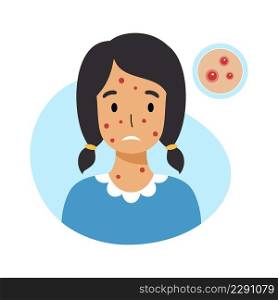 Sad girl with chicken pox on her face. Skin inflammation and acne in adolescents.
