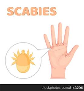 Scabies. contagious skin infestation. scabies mite and Human’s skin with Magnified view of a burrowing trail of the mite.