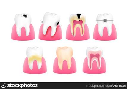 Set of healthy and unhealthy tooth. Tooth decay and gum. Dental care concept. Illustration.