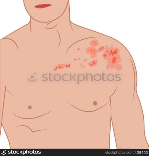 Shingles blisters on a human body. Dermatology disease zoster, contagious infection, red herpes spots on a human body vector illustration
