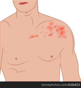 Shingles blisters on a human body. Dermatology disease zoster, contagious infection, red herpes spots on a human body vector illustration