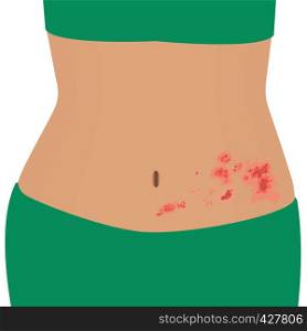 Shingles or zoster on a woman body vector illustration. Dermatology disease contageous infection