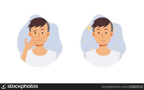 Skin care concept.Before and after acne treatment procedure.A man with acne problem. Flat vector cartoon character illustration.