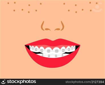 Smile with dental braces. Cartoon medical correct bite of teeth, vector illustration of orthodontic treatment for teeth in mouth by alignment. Smile with dental braces