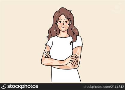 Smiling young woman with skin disease feel body positive. Happy girl on vitiligo international day. Depigmentation day. Skincare problem concept. Flat vector illustration. . Smiling woman with skin vitiligo disease